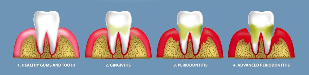 The stages of gum disease