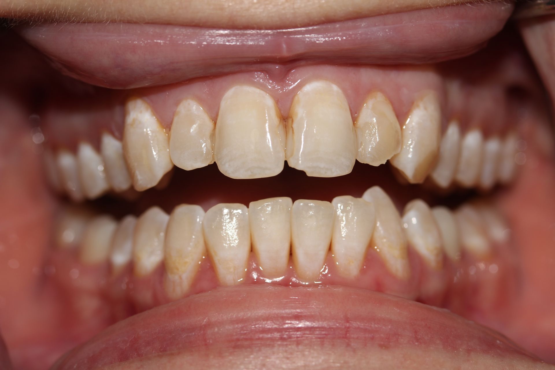 Before treatment