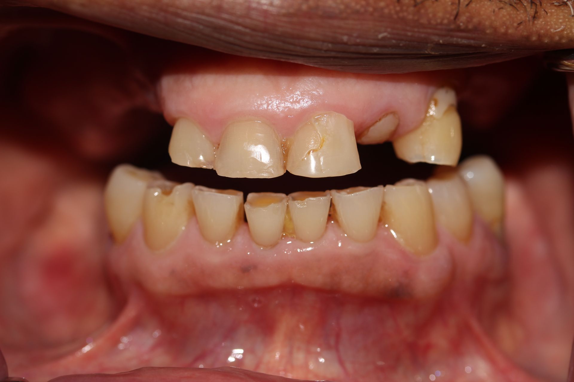 Before treatment