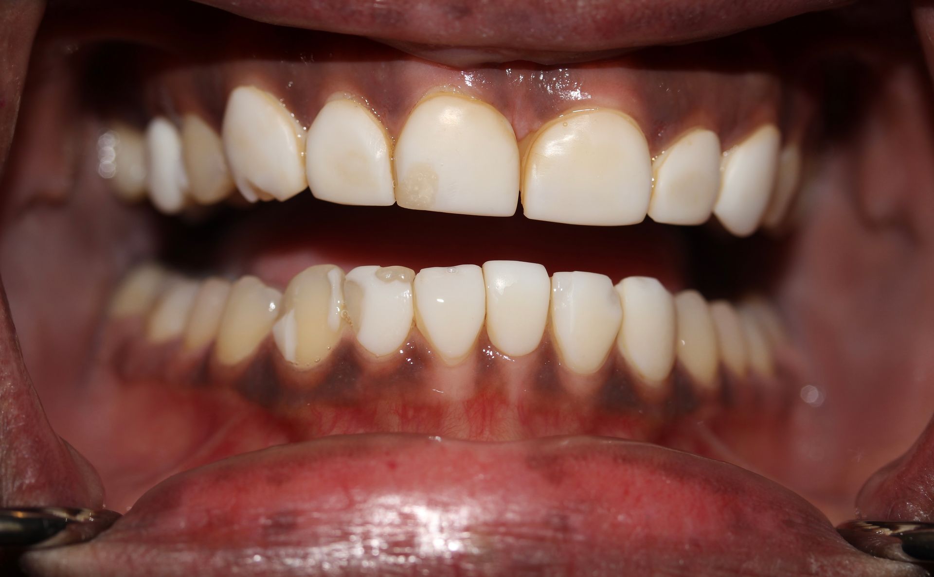Before treatment