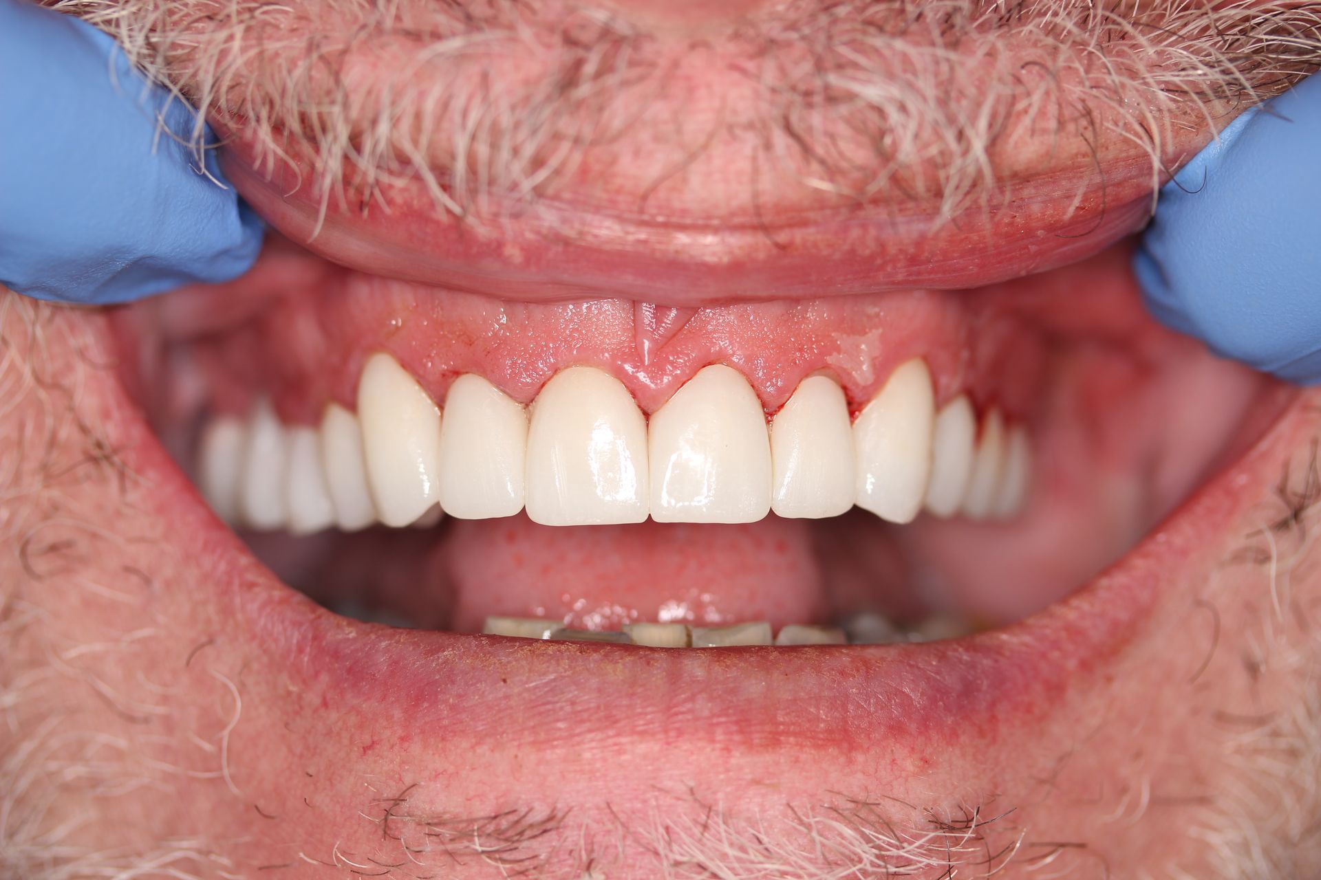 After treatment