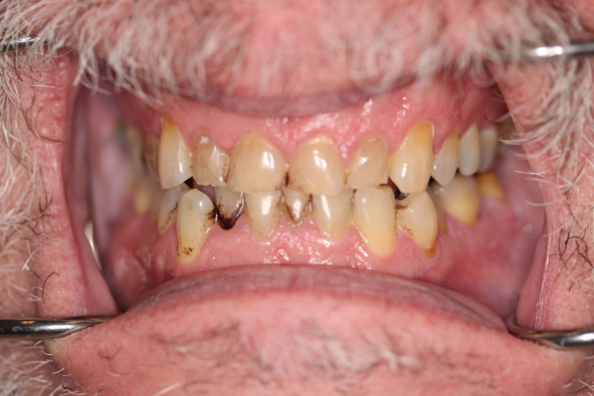Before treatment
