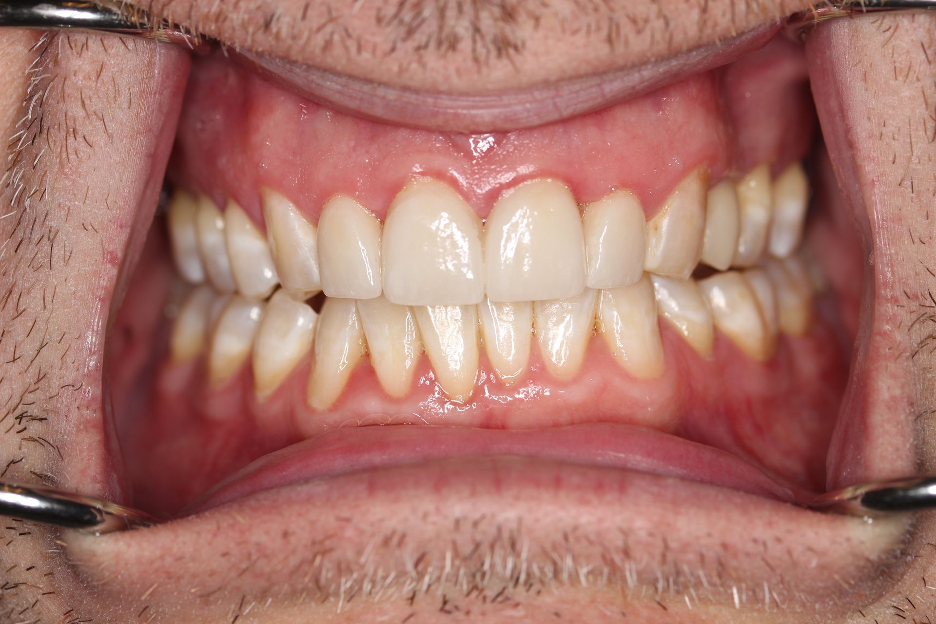 After treatment