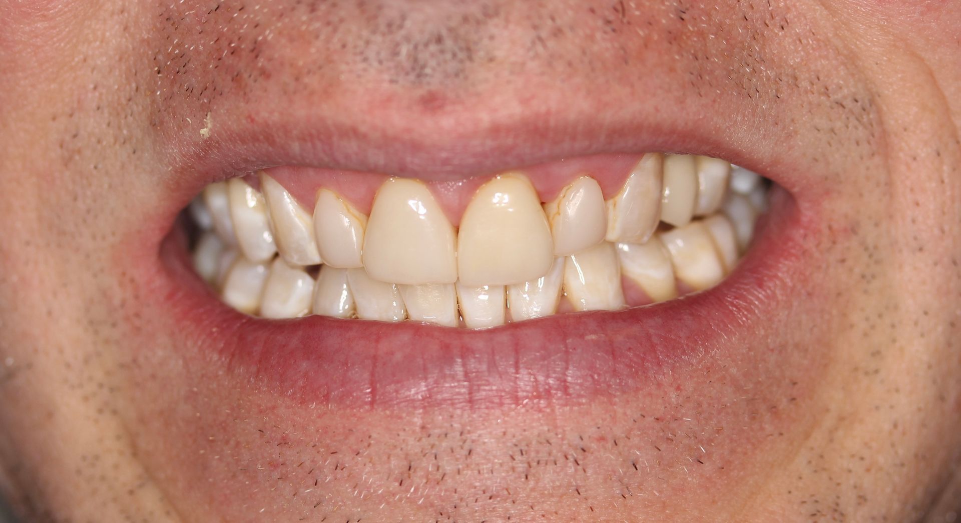Before treatment