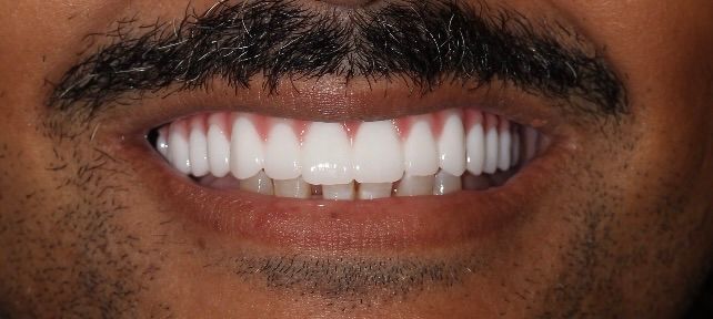 After treatment