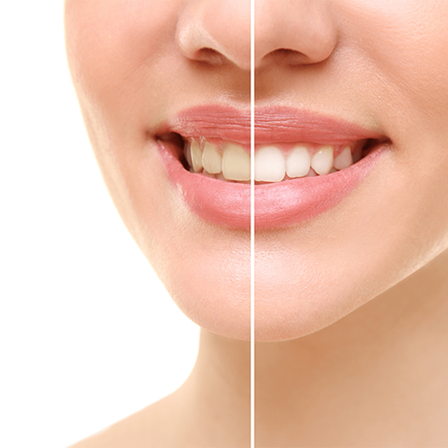 Teeth Whitening