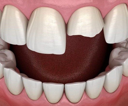 Dental Bonding