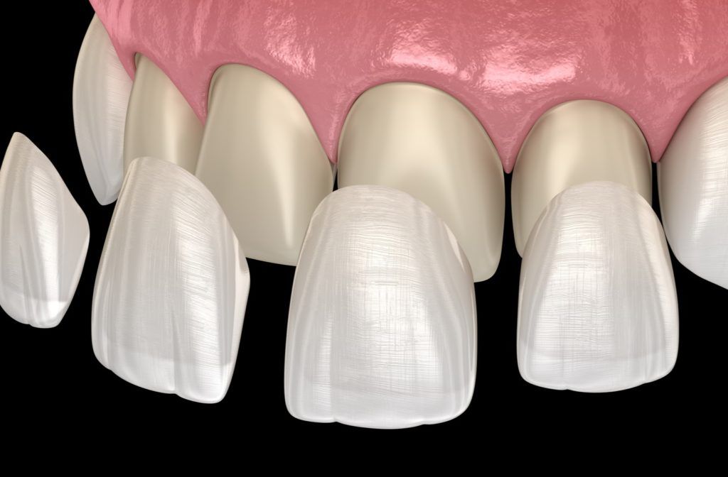 Ceramic Veneers