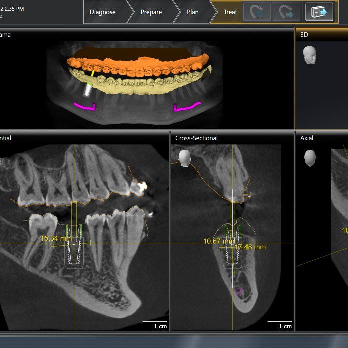 Digital Implant Planning